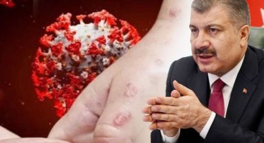 Türkiye'de İlk Maymun Çiçeği Vakası Görüldü!